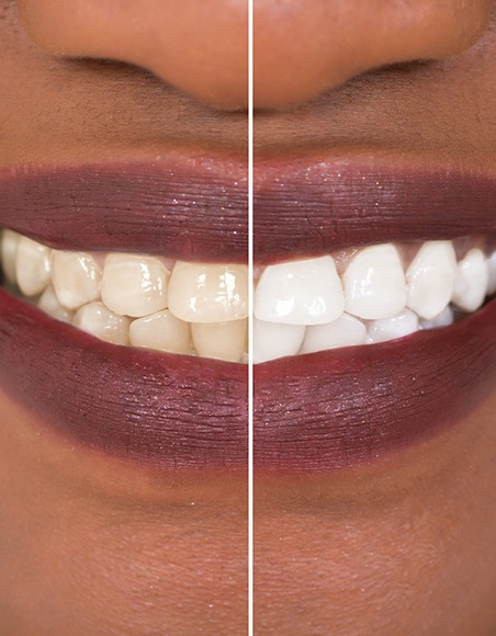 Closeup of patient's smile before and after teeth whitening